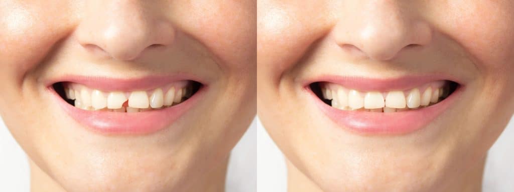 broken tooth repair